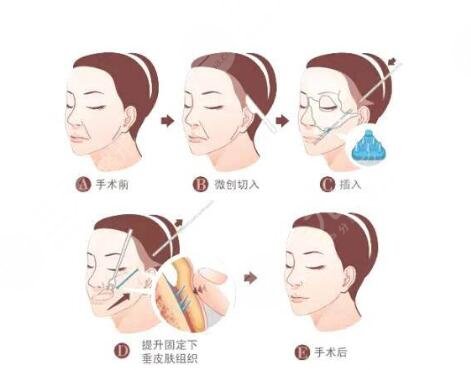 泉州拉皮手術(shù)真實果