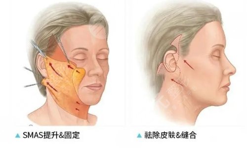 面部拉皮手術(shù)能維持幾年？可以保持多久？提升果和視頻網(wǎng)友分享~