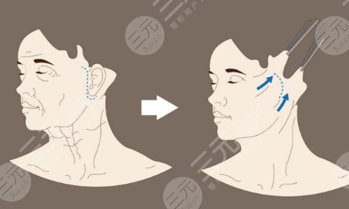 面部拉皮手術(shù)能維持幾年