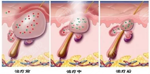 痘坑凹洞能不能修復(fù)？多少錢？價(jià)格一覽+4個(gè)有的方法盤點(diǎn)！