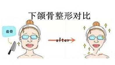 下頜角切除一般多少錢