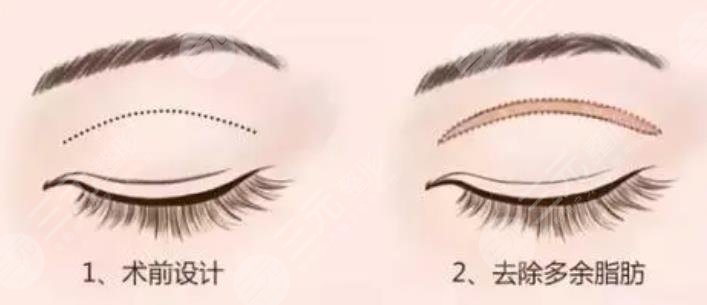 雙眼皮