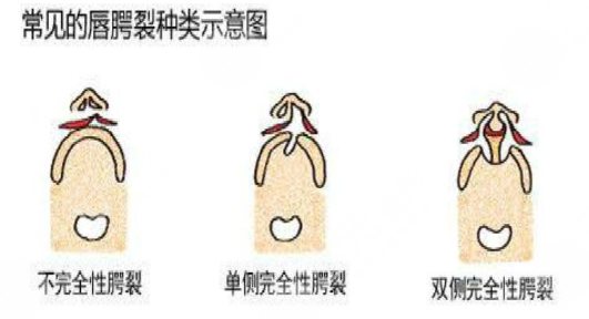 唇腭裂鼻子修復(fù)多大年齡合適？唇腭裂修復(fù)過(guò)程和時(shí)間需要多久？