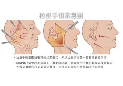 拉皮手術(shù)能維持幾年？這幾種屬于禁忌人群！醫(yī)美抗衰莫盲目~