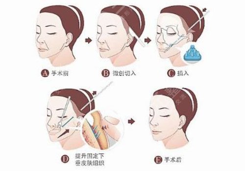 拉皮手術(shù)禁忌人群