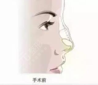 駝峰鼻