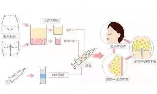 自體脂肪填充太陽凹陷能維持多久？多少錢？疼嗎？附價(jià)格表+注意事項(xiàng)
