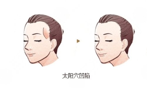 自體脂肪填充太陽凹陷能維持多久？多少錢？疼嗎？附價(jià)格表+注意事項(xiàng)