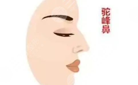 駝峰鼻