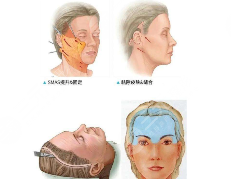 拉皮手術(shù)傷口會(huì)不會(huì)留疤？疤痕多久消失？手術(shù)注意事項(xiàng)30秒速讀
