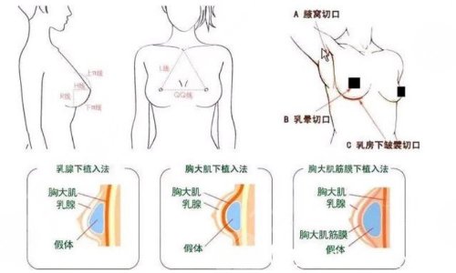 假體隆胸后的注意事項(xiàng)有哪些?