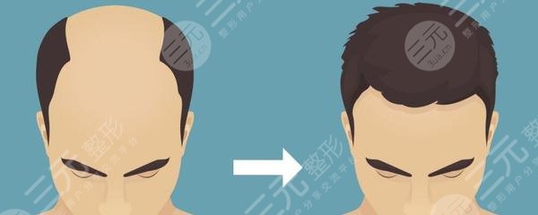 海南省人民醫(yī)院植發(fā)
