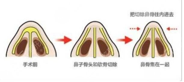 鷹鉤鼻