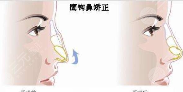 鷹鉤鼻