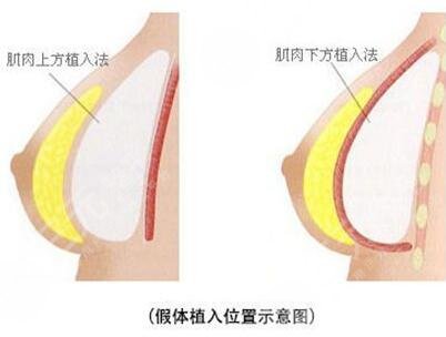 康寧假體和德美分別是？