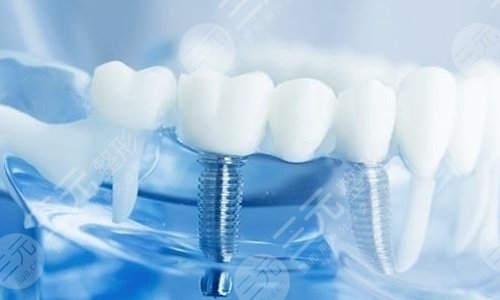 口腔問(wèn)答一：種植牙壽命是多少年?