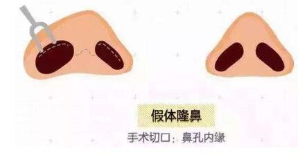 什么是鼻部手術(shù)手術(shù)項(xiàng)目？