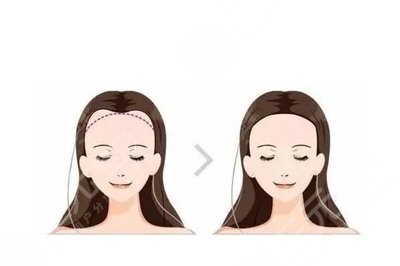 成都植發(fā)案例反饋前