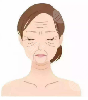 濟南省立醫(yī)院整形科玻尿酸填充除皺手術案例分享