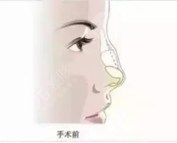 歪鼻矯正