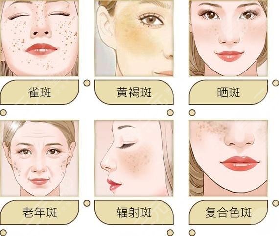 淮安市第一人民醫(yī)院激光祛斑網(wǎng)友親身體驗(yàn)日記|案例:術(shù)前