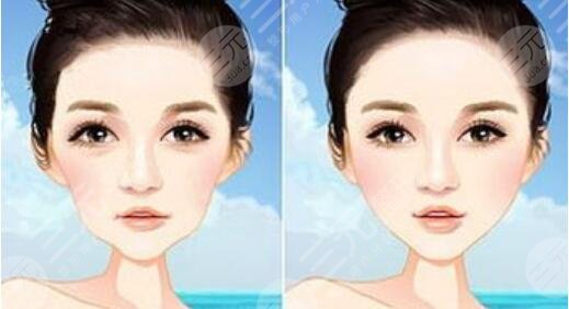 合肥藝星醫(yī)療美容醫(yī)院隆鼻案例分享