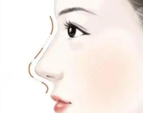隆鼻動漫