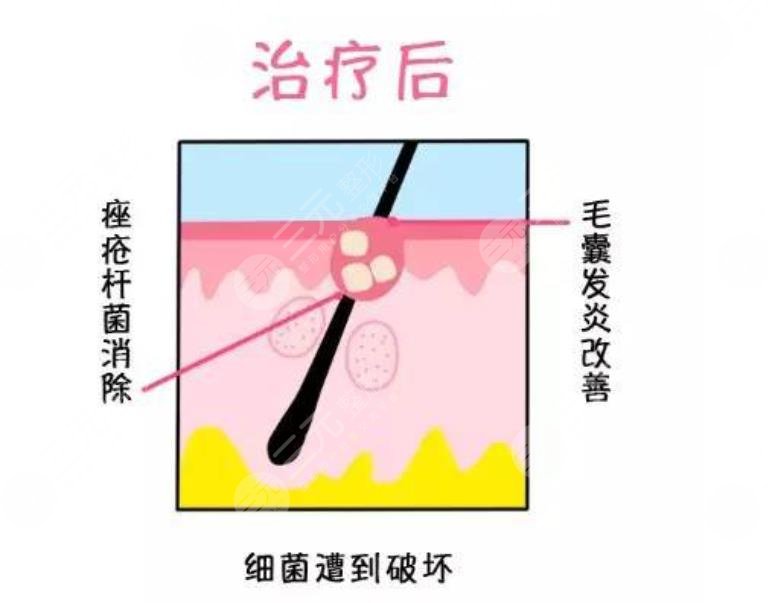 中山三院美容激光科紅藍(lán)光去黑色素案例：術(shù)后