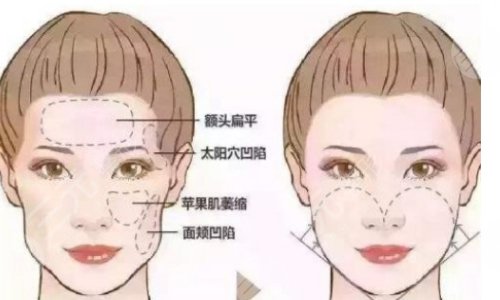 自體脂肪填充面部