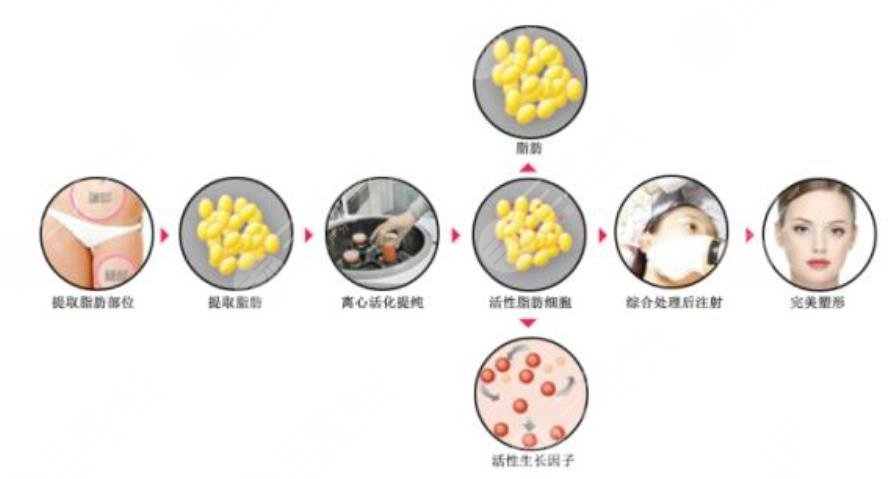 脂肪填充