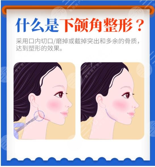 下頜角整形術(shù)有危險(xiǎn)嗎？費(fèi)用大概多少錢？?jī)r(jià)格表附上