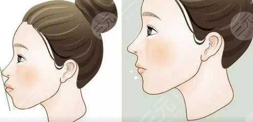 凸嘴矯正