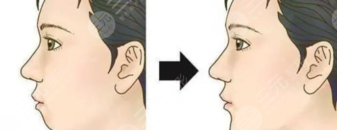 凸嘴矯正