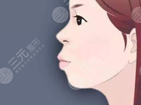 凸嘴矯正