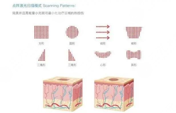 廣州南方醫(yī)院點(diǎn)陣激光案例