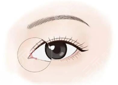 術(shù)后護(hù)理不到位