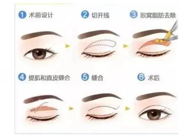 雙眼皮手術(shù)常見手法  　　1、埋線法