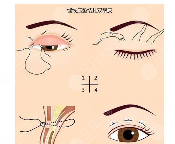 壓線法