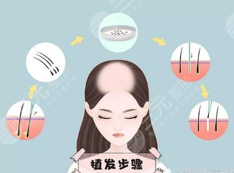 植發(fā)手術(shù)項(xiàng)目科普