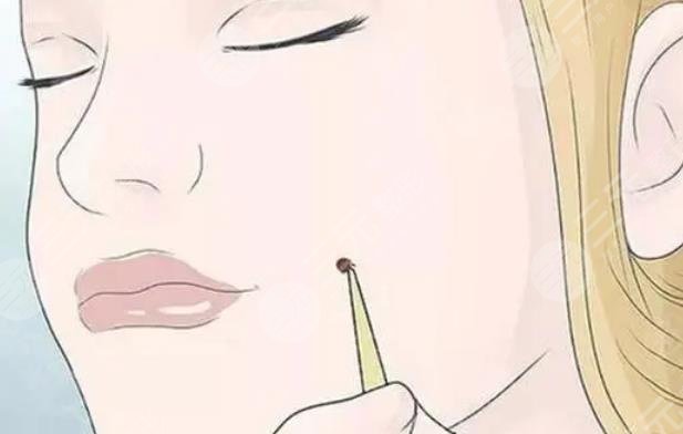 激光臉部點痣1到7天圖片恢復(fù)全過程，不再做“痣”女孩~