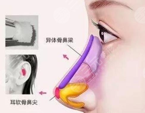 隆鼻
