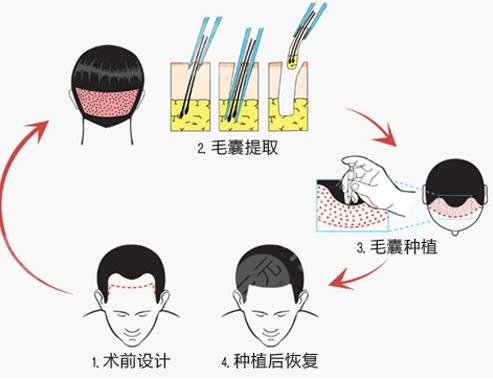 M型植發(fā)項目相關(guān)科普