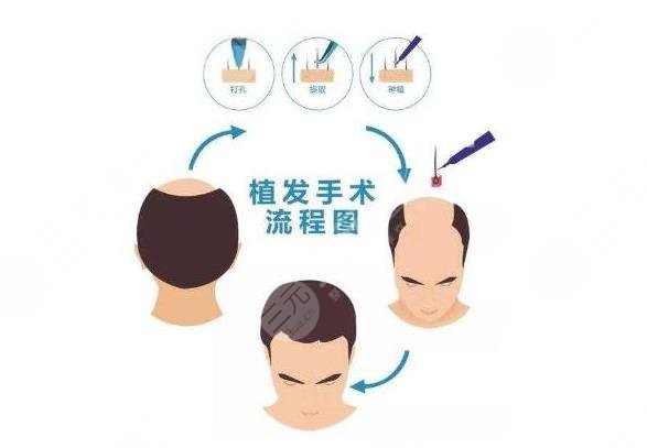 頭發(fā)種植項目相關(guān)科普
