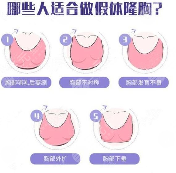 隆胸假體