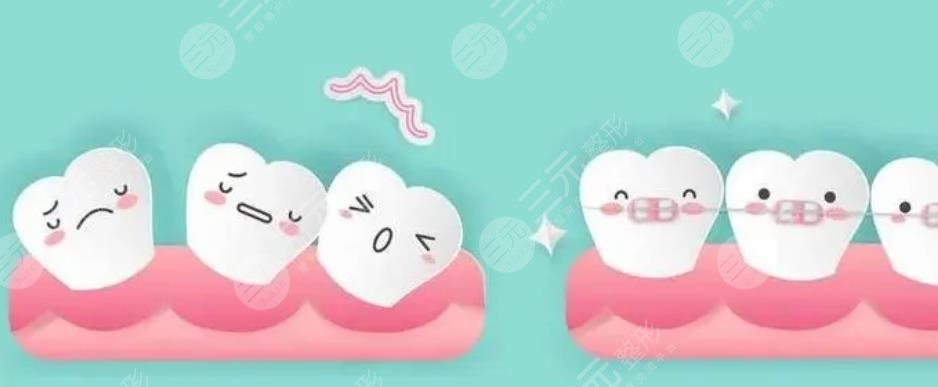 舌側(cè)矯正