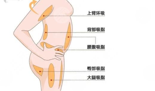 脂肪體雕