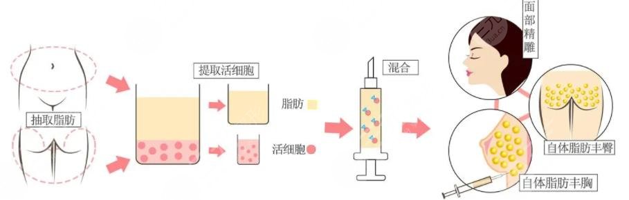 脂肪體雕
