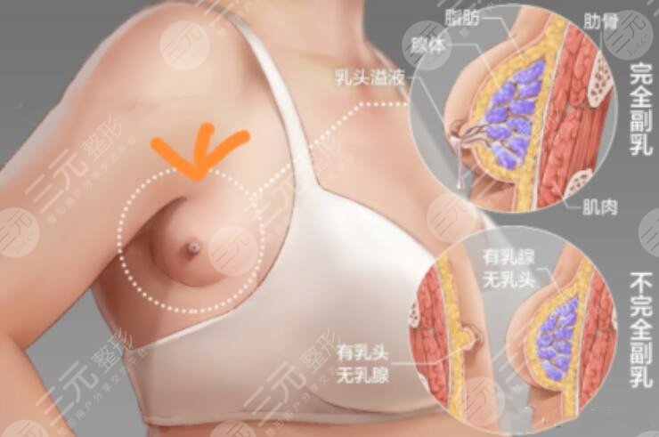 切除副乳對比圖片，真人展示切除副乳術(shù)后1個月，她說沒了副乳后終于敢秀身材了~
