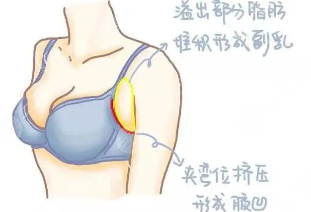 切除副乳手術(shù)后一天