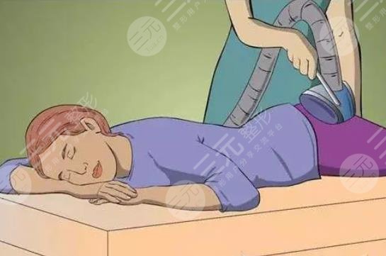 體雕溶脂